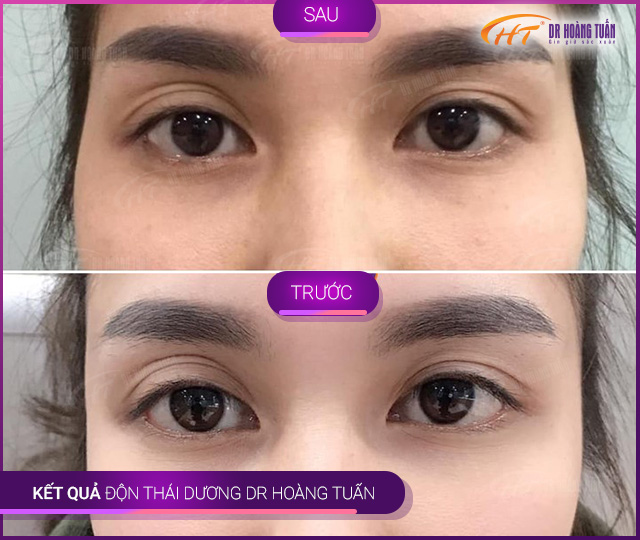 Kết quả độn thái dương tại Thẩm mỹ Hoàng Tuấn